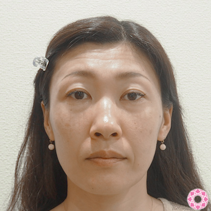 年代：40代 施術名：シワ取り（ボトックス） 施術前｜東京形成美容外科