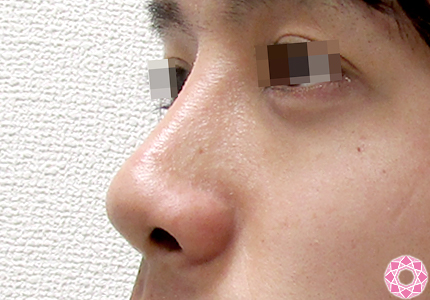 年代：20代 施術名：隆鼻術（シリコンプロテーゼ） 施術後｜東京形成美容外科