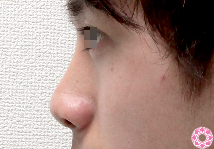 年代：20代 施術名：隆鼻術（シリコンプロテーゼ） 施術前｜東京形成美容外科