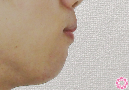 年代：20代 施術名：唇を薄く 施術前｜東京形成美容外科