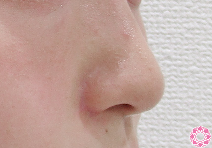 年代：10代 施術名：小鼻縮小 施術前｜東京形成美容外科