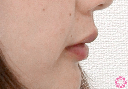 年代：30代 施術名：唇を厚く（ヒアルロン酸） 施術前｜東京形成美容外科