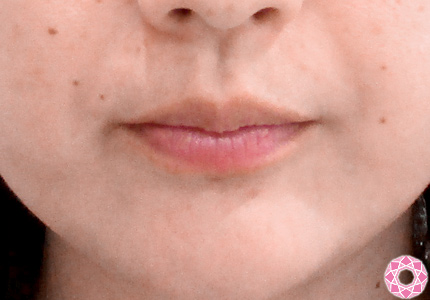 年代：30代 施術名：唇を厚く（ヒアルロン酸） 施術前｜東京形成美容外科