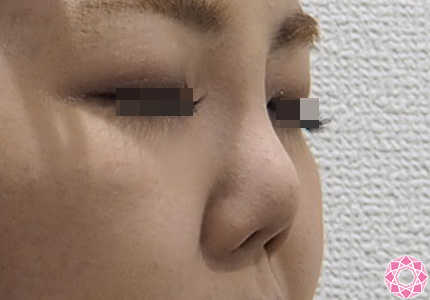 隆鼻術 シリコンプロテーゼ で鼻根から高い鼻に 症例写真 画像 公式 東京形成美容外科 美容外科 美容皮膚科 船橋駅から徒歩3分