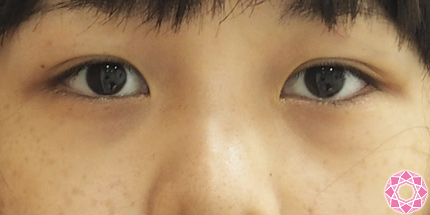 年代：10代 施術名：目の下のふくらみ取り 施術前｜東京形成美容外科