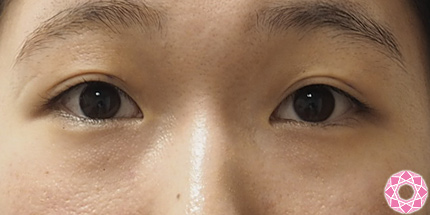 薄い二重を二重埋没法でクッキリ 公式 東京形成美容外科 美容外科 美容皮膚科 船橋駅から徒歩3分