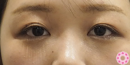 三重になっているまぶたを二重埋没法できれいな二重に 公式 東京形成美容外科 美容外科 美容皮膚科 船橋駅から徒歩3分