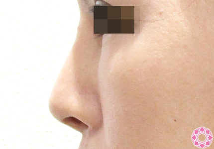 年代：40代 施術名：隆鼻術（シリコンプロテーゼ） 施術前｜東京形成美容外科