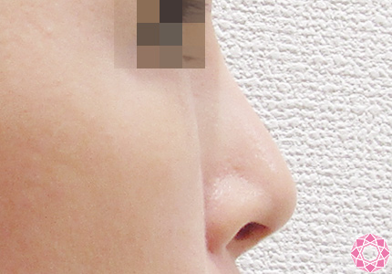 年代：40代 施術名：隆鼻術（シリコンプロテーゼ） 施術前｜東京形成美容外科