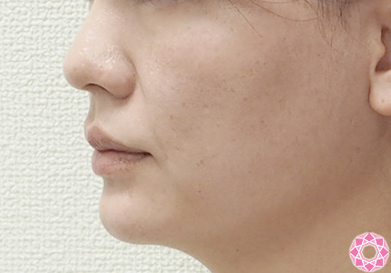 年代：30代 施術名：シワ取り（ヒアルロン酸） 施術前｜東京形成美容外科