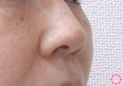 年代：30代 施術名：小鼻縮小 施術前｜東京形成美容外科