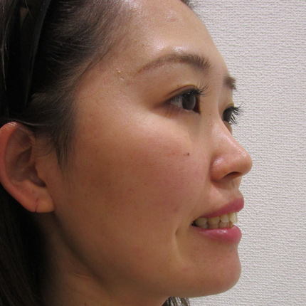 年代：20代 施術名：ガミースマイル（ボトックス）・ガミースマイル（切開） 施術前｜東京形成美容外科