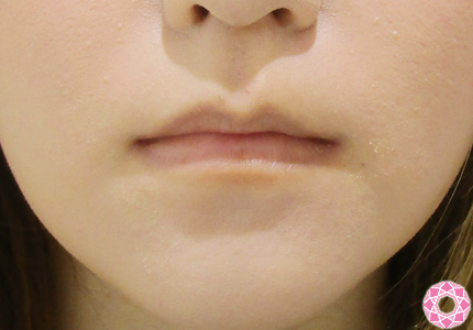 薄い下唇を厚く ヒアルロン酸 バランスいいぷっくり唇に 公式 東京形成美容外科 美容外科 美容皮膚科 船橋駅から徒歩3分