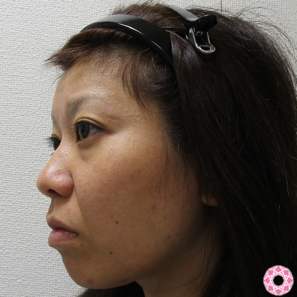 年代：30代 施術名：プチ隆鼻術（ヒアルロン酸） 施術前｜東京形成美容外科