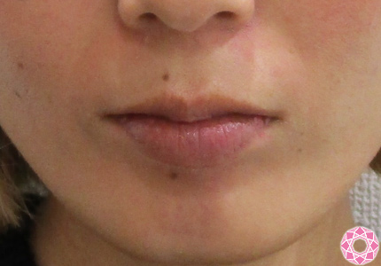 唇を厚く ヒアルロン酸 症例写真 美容整形のことなら千葉県船橋市の東京形成美容外科 美容皮膚科 船橋駅から徒歩3分