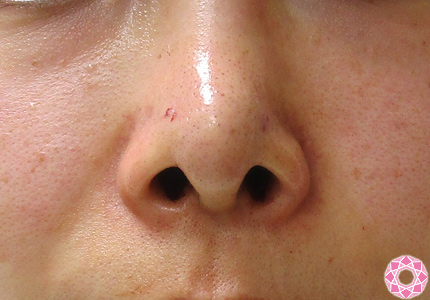 鼻先 ダンゴ鼻 修正 症例写真 美容整形のことなら千葉県船橋市の東京形成美容外科 美容皮膚科 船橋駅から徒歩3分