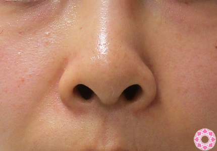 鼻先 団子鼻 鼻整形 美容整形のことなら千葉県船橋市の東京形成美容外科 美容皮膚科 船橋駅から徒歩3分