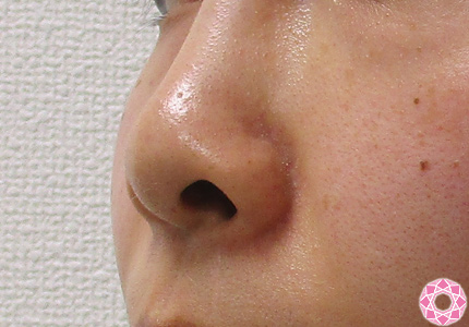 日本人特有の団子鼻も1day鼻尖縮小でスッと高い鼻先に 症例写真 画像 公式 東京形成美容外科 美容外科 美容皮膚科 船橋駅から徒歩3分