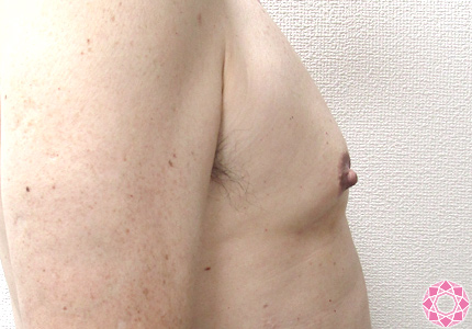 薄着でも気にならない 男性の乳頭縮小 症例写真 画像 公式 東京形成美容外科 美容外科 美容皮膚科 船橋駅から徒歩3分