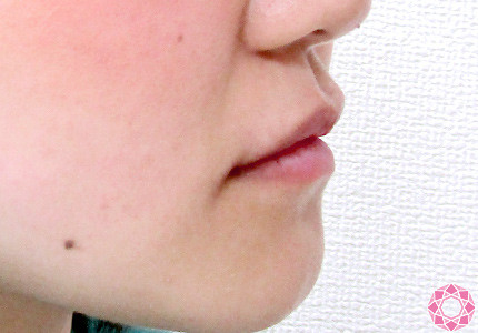 年代：10代 施術名：唇を厚く（ヒアルロン酸） 施術前｜東京形成美容外科