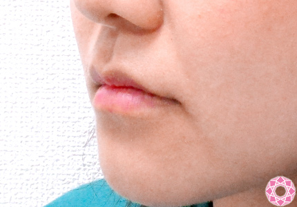 年代：10代 施術名：唇を厚く（ヒアルロン酸） 施術前｜東京形成美容外科