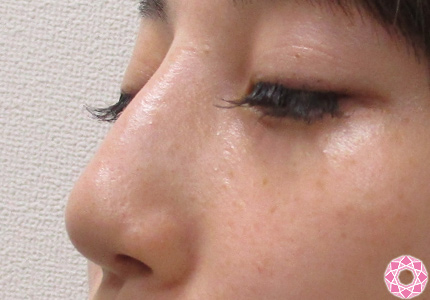 年代：30代 施術名：隆鼻術（シリコンプロテーゼ） 施術後｜東京形成美容外科