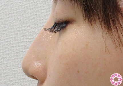 年代：30代 施術名：隆鼻術（シリコンプロテーゼ） 施術前｜東京形成美容外科