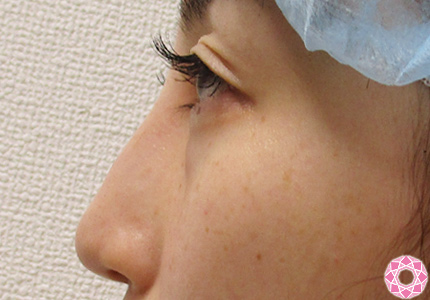 年代：30代 施術名：隆鼻術（シリコンプロテーゼ） 施術前｜東京形成美容外科