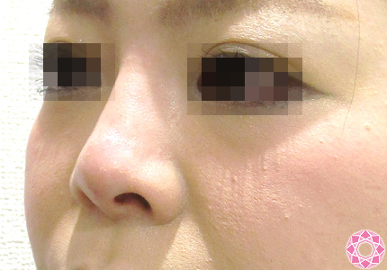 年代：30代 施術名：プチ隆鼻術（ヒアルロン酸） 施術後 拡大画像｜東京形成美容外科