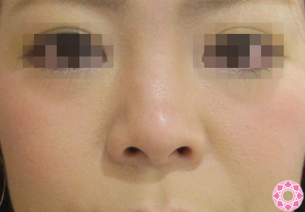 年代：30代 施術名：プチ隆鼻術（ヒアルロン酸） 施術前｜東京形成美容外科
