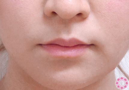 年代：20代 施術名：唇を厚く（ヒアルロン酸） 施術前｜東京形成美容外科