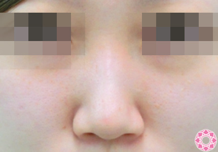 年代： 施術名：隆鼻術（シリコンプロテーゼ） 施術前｜東京形成美容外科