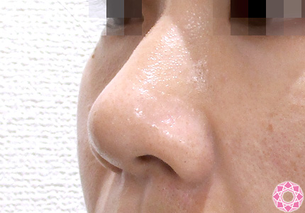 年代：20代 施術名：小鼻縮小 施術前｜東京形成美容外科