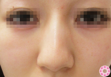 年代：10代 施術名：プチ隆鼻術（ヒアルロン酸） 施術前｜東京形成美容外科