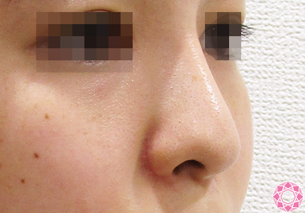 年代：20代 施術名：隆鼻術（シリコンプロテーゼ） 施術前｜東京形成美容外科