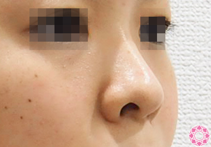 年代：20代 施術名：隆鼻術（シリコンプロテーゼ） 施術前 拡大画像｜東京形成美容外科