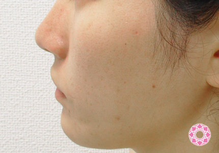 年代：20代 施術名：小顔脂肪吸引 施術前｜東京形成美容外科