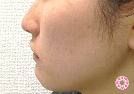 年代：20代 施術名：小顔脂肪吸引 施術前｜東京形成美容外科