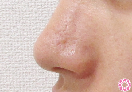 年代：20代 施術名：鼻先（ダンゴ鼻）修正 施術前｜東京形成美容外科
