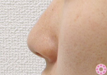 年代：20代 施術名：鼻先（ダンゴ鼻）修正 施術前｜東京形成美容外科