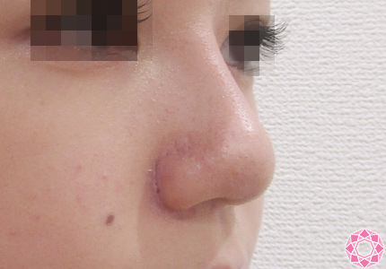 年代：20代 施術名：隆鼻術（シリコンプロテーゼ） 施術後｜東京形成美容外科