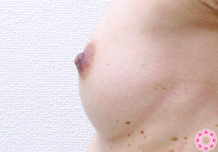 年代：40代 施術名：乳頭縮小・乳頭縮小（乳管温存法） 施術前｜東京形成美容外科