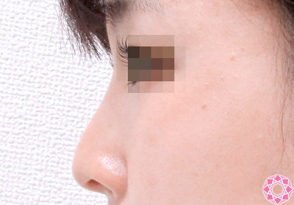 年代：20代 施術名：プチ隆鼻術（ヒアルロン酸） 施術前｜東京形成美容外科