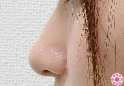 年代：20代 施術名：小鼻縮小 施術前｜東京形成美容外科