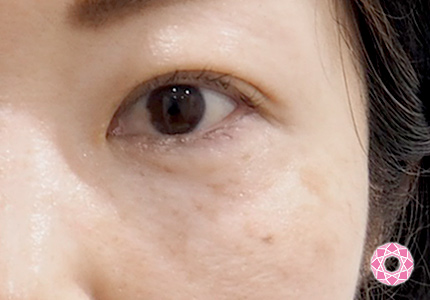 シミ取りレーザー ｑスイッチ 症例写真 美容整形のことなら千葉県船橋市の東京形成美容外科 美容皮膚科 船橋駅から徒歩3分