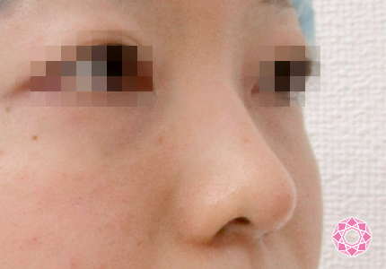 年代：20代 施術名：隆鼻術（シリコンプロテーゼ） 施術前 拡大画像｜東京形成美容外科