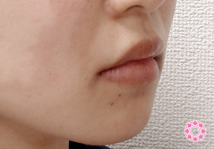年代：20代 施術名：唇を薄く 施術前｜東京形成美容外科