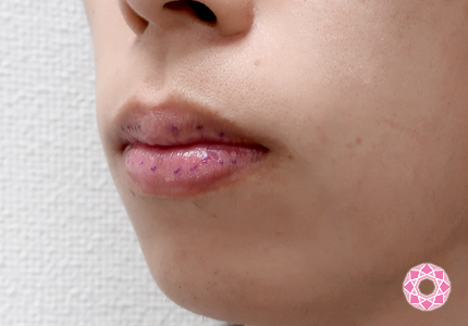 年代：30代 施術名：唇を薄く 施術前｜東京形成美容外科