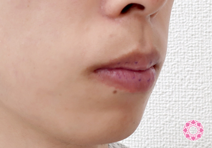 年代：30代 施術名：唇を薄く 施術前｜東京形成美容外科