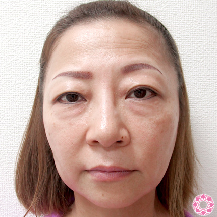 年代：50代 施術名：目の下のふくらみ取り 施術前｜東京形成美容外科